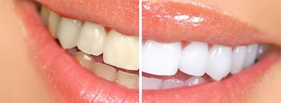 Как отбелить зубы дома без вреда для эмали