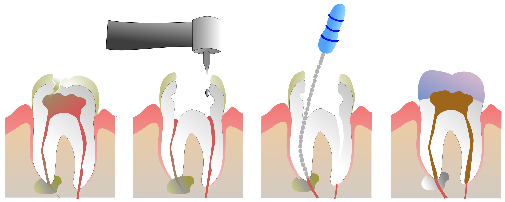4 Канальный пульпит зуба. Пульпит 2 канального зуба. Периодонтит 1 канальный. Обработка и пломбирование корневых каналов